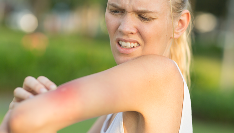 A woman itching an inflamed mosquito bite on their arm.