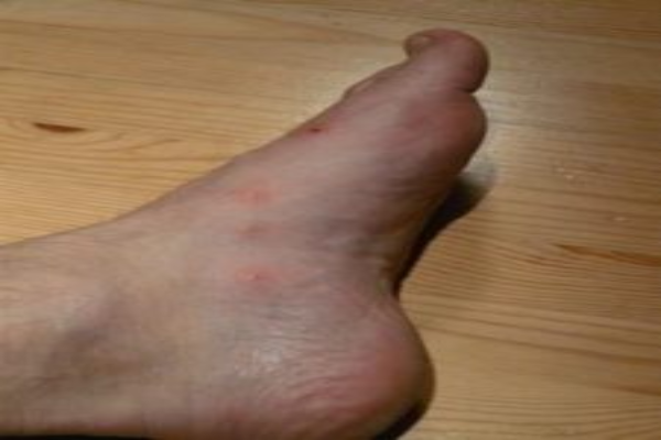 A human foot with visible red spots.