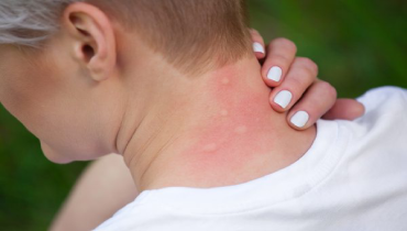 Woman scratching the back of her neck with several mosquito bites.