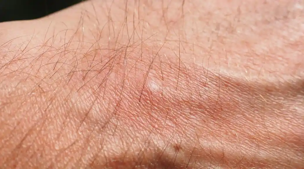 Mosquito bite in the hand.