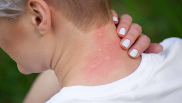 Close-up of a noticeable rash indicating skin irritation.