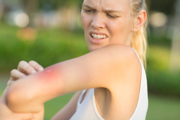 Young woman with large red mosquito bite on her arm scratching.